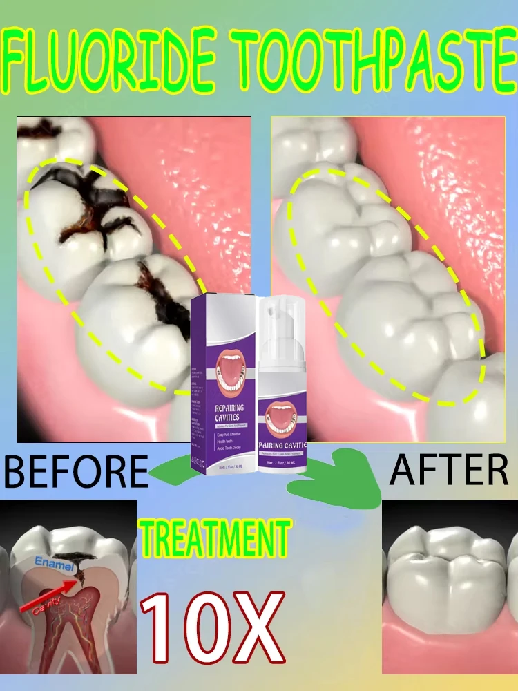 Teeth Whitening Best - Hot sales Best-selling, Scientific Repairs Cavities,