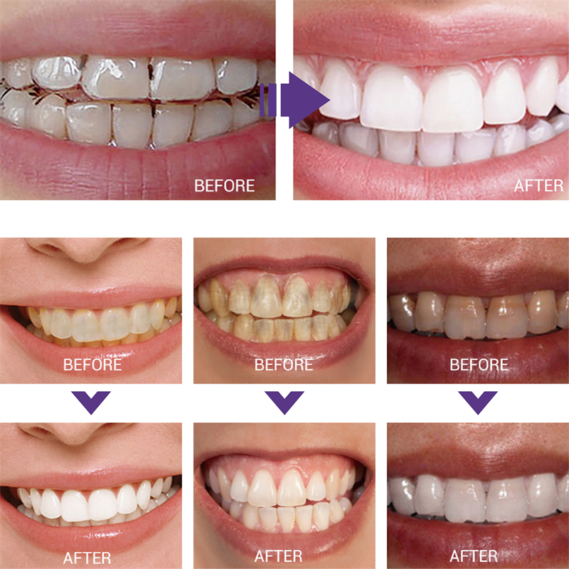 1pcs Teeth Cleansing Whitening - Teeth Whitening In Korea ulasan dan harga
