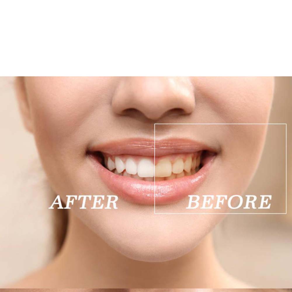 Top Quality Peroxide Teeth Whi - Teeth Whitening Light Kit ulasan dan harga
